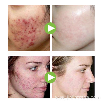 Acne Treatment Repair Aloe Vera Gel Skin Care